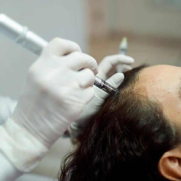 Microneedling Capilar — Dra. Raisa Resende
